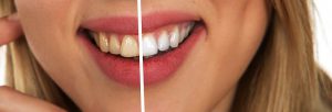 Rodzaje i zastosowanie irygatorów dentystycznych