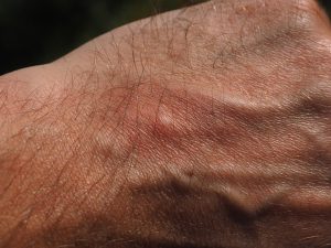 Alergia i dolegliwości alergiczne. Jak leczyć?
